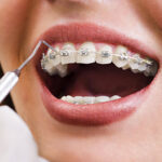 dental-braces-or-clips