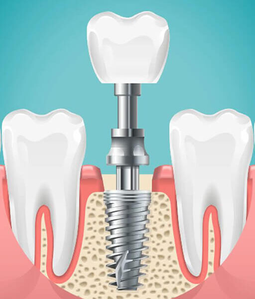 dental-implants