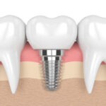 implantology