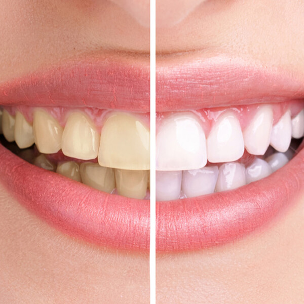 teeth-whitening