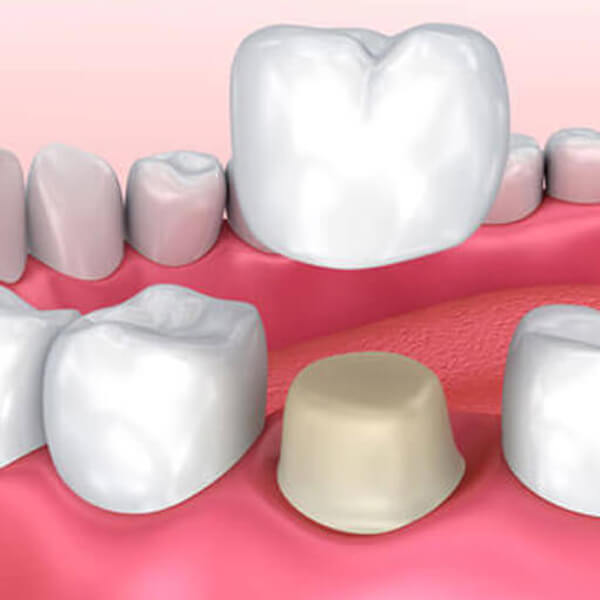 dental-crown