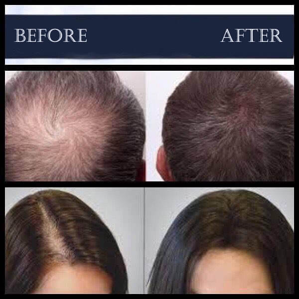 PRP-Treatment-For-Hair-Loss