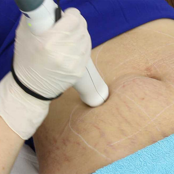 laser-stretch-mark-reduction