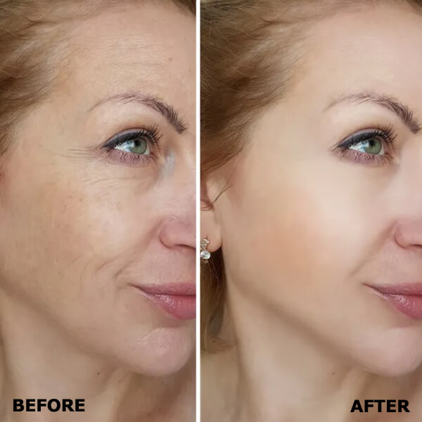 skin-rejuvenation-resurfacing